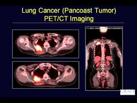 How Does Cancer Appear On A Pet Scan - PetsWall