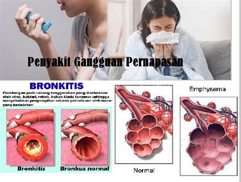 Sebutkan 4 Macam Penyakit Pada Sistem Pernapasan Manusia Beserta Penjelasannya Homecare24