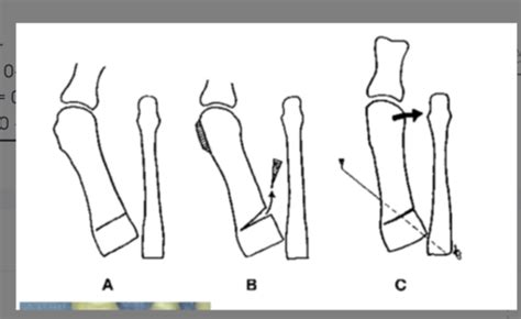 Hallux Valgus Surgery Flashcards Quizlet