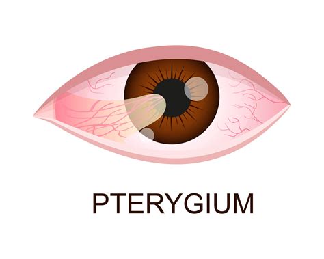 Pterygium Vs Pinguecula Isight Clinics