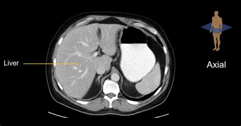 Abdominal Ct Planes • Litfl • Radiology Library