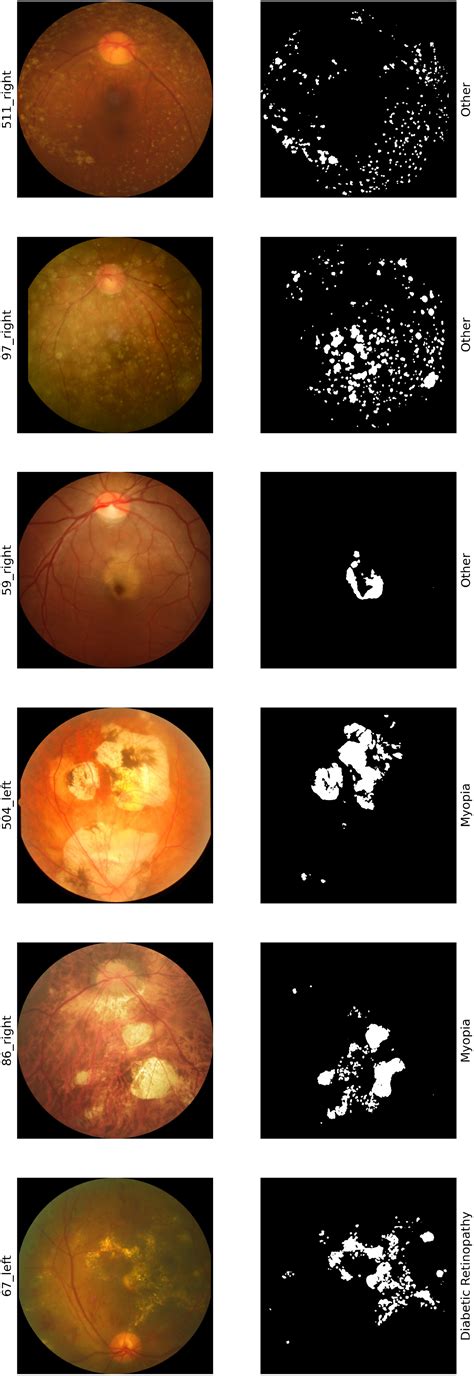 Drusen‐aware Model For Age‐related Macular Degeneration Recognition