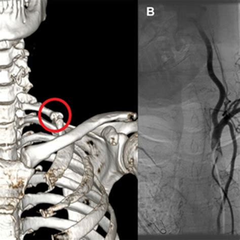 A Angiotomografía costilla cervical bilateral con fusión costal