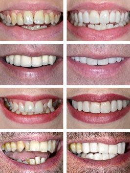 Dental Crown Procedure and Fitting | The Perfect Smile