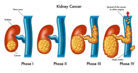 Cancer De Rein Photo Stock Image Du Métastase Hypertension 54591462