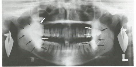 Lp Extra Oral Radiography Flashcards Quizlet