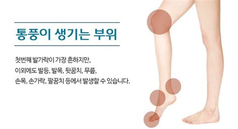 통풍성관절염 어떻게 치료해야하나요 새움병원