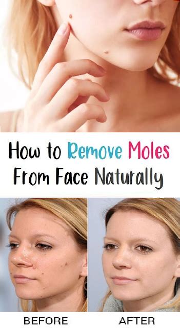 How To Remove Moles From Your Face Naturally And Quickly