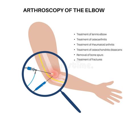 Arthroscopy Stock Illustrations 179 Arthroscopy Stock Illustrations