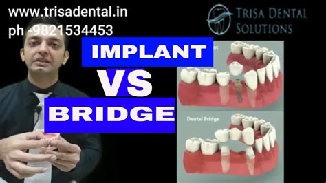 Which Is Better Implant Or Bridge Dental Bridge Or Implant Decision