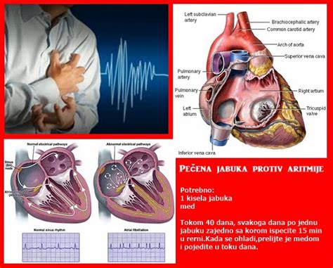 Aritmija srca simptomi i liječenje Journal de Luxe MItoTako