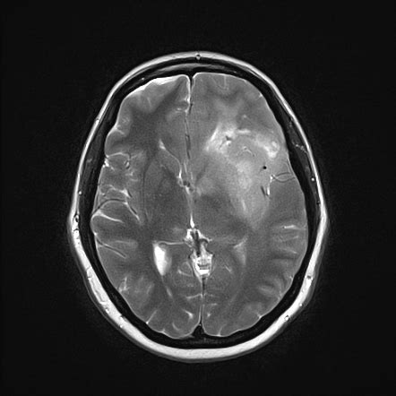 Anaplastic astrocytoma | Radiology Reference Article | Radiopaedia.org