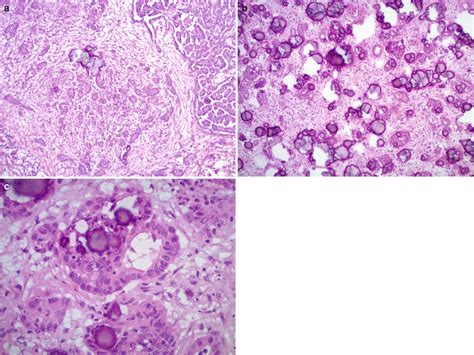 Ovarian Epithelial Tumors Basicmedical Key