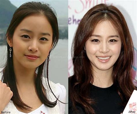 Kim Tae Hee Plastic Surgery Before and After – Celebrity Plastic ...