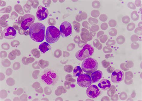 precursor syndrome stock  pictures royalty  images