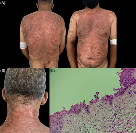 A Clinical Examination On Admission Showing Scales And Crusts With Download Scientific