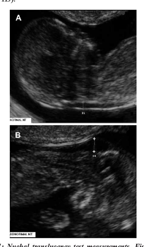 Figure 1 From Evaluation Of Nuchal Translucency Measurement In First