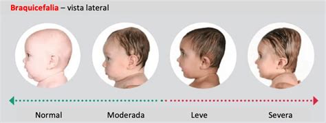 Braquicefalia O Que É - Hablemos de la braquicefalia y su tratamiento - Plagiocefalia