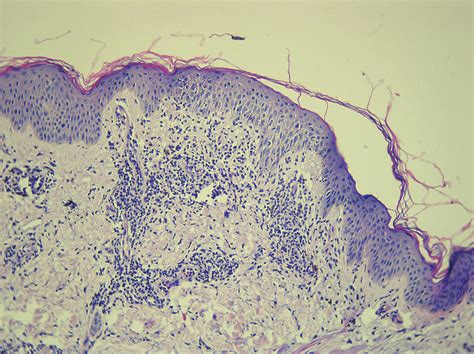 Spongiotic Epidermis With Hydropic Degeneration Of The Basal Layer And