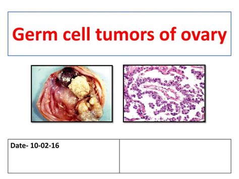 Germ Cell Tumors Of Ovary Ppt