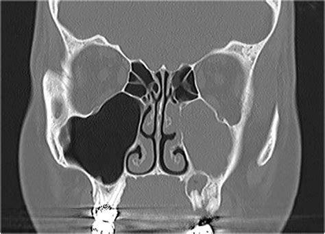 odontogenic maxillary sinusitis  comprehensive review pmc