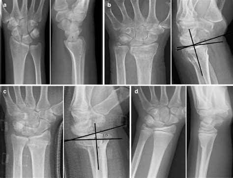 Examples Of Common Fractures And Injuries A Intra Articular