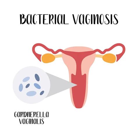 100 000 Bacterial Vaginosis Vector Images Depositphotos