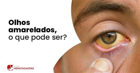 O Que Pode Ser Olhos Amarelados - Olhos Amarelados, O Que Pode Ser? - Clínica Hepatogastro