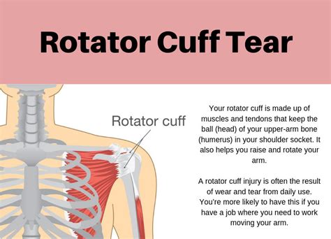 Arthroscopic Shoulder Surgery For The Treatment Of Rotator Cuff Tears