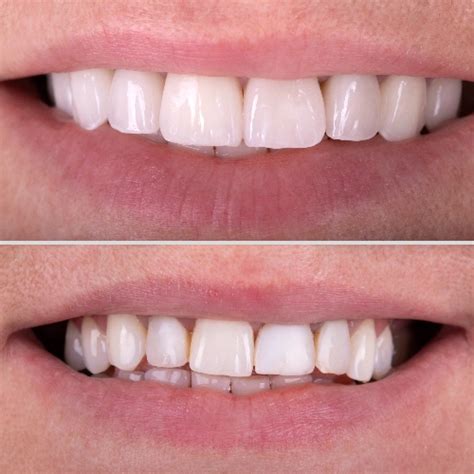 Smile Transformation Dentfirst Dental Care