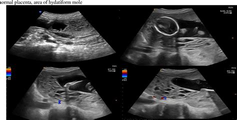 Figure 1 From Twin Pregnancy Involving A Molar Pregnancy And Living Fetus About Two Cases