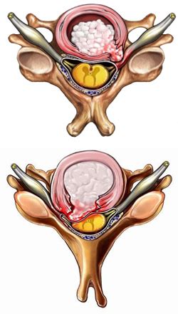 H Rnia De Disco Cervical Dr Ernani Abreu M Dico Cirurgi O De Coluna