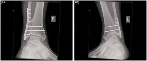 Distal Tibiofibular Joint Ankle