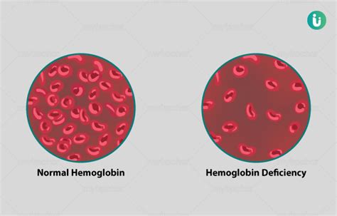 Hemoglobin Levels: High Low, Symptoms, And Risk Factors, 57% OFF