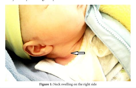 Figure 2 From Fibromatosis Colli A Rare Cause Of Neck Mass In Infants A Case Report Semantic