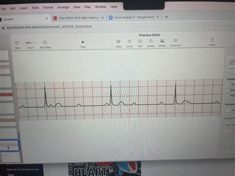 Ekgs Flashcards Quizlet