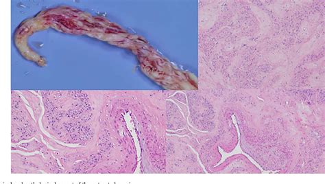 Figure From Intravascular Leiomyomatosis With Intracardiac Extension