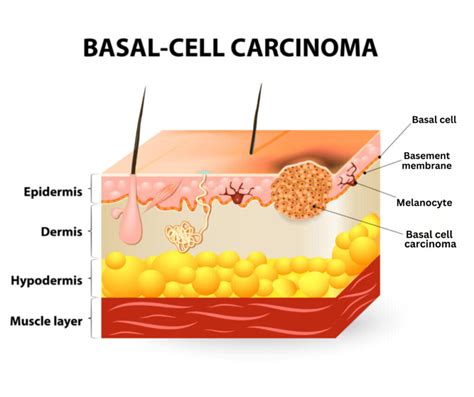 Sobre El Carcinoma De Células Basales O Basilioma Aim At Skin Cancer