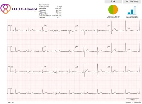 Mild first degree AV block, Sinus bradycardia - Ambulatory ECG Holter monitoring - ECG On-Demand