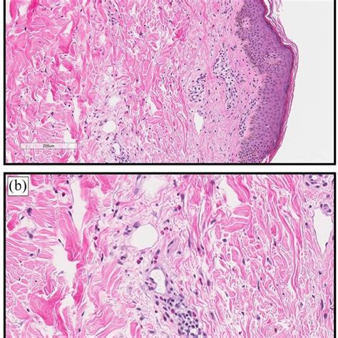 Skin Section Obtained From A Skin Punch Biopsy From The Right Thigh Of