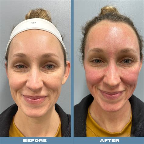 My Microneedling Real Life Before And After Experience Cornerstone Dermatology And Surgery Group