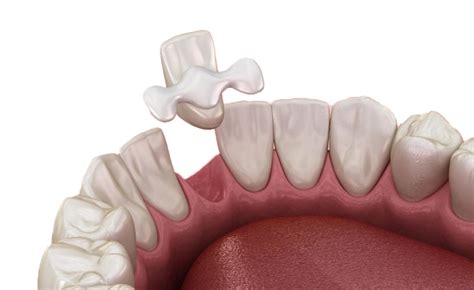 maryland bonded bridges kosh dental