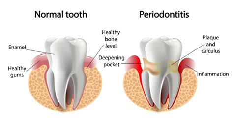 Gum Disease Piedmont Dental Associates