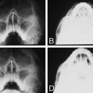 (PDF) Intraoral Zygoma Reduction Using L-shaped Osteotomy