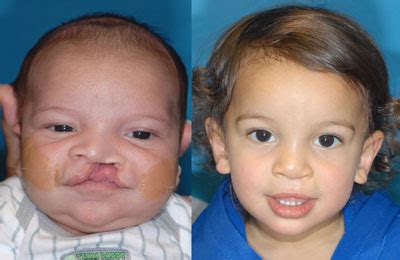 Pediatric Plastic Surgery - Sheraz Plastic Surgery