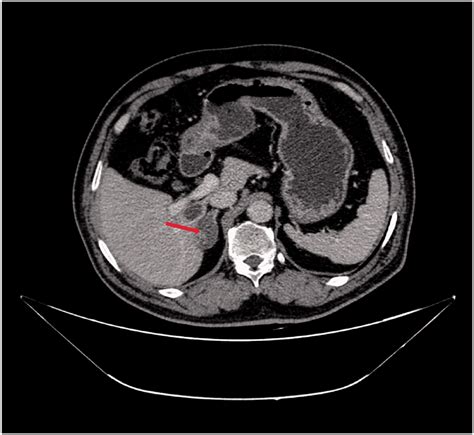 Abdominal Enhanced Computed Tomography Scan Showing A Low Density Oval