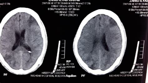 Space Occupying Lesion Brain Sol Brain Youtube