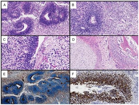 Synchronous Small Cell Neuroendocrine Carcinoma Of The Cervix And