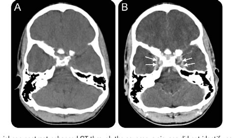 Figure 1 From Pediatric Cavernous Sinus Thrombosis Semantic Scholar