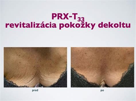 Biorevitalization Peeling PRX T33 Bratislava Vitality